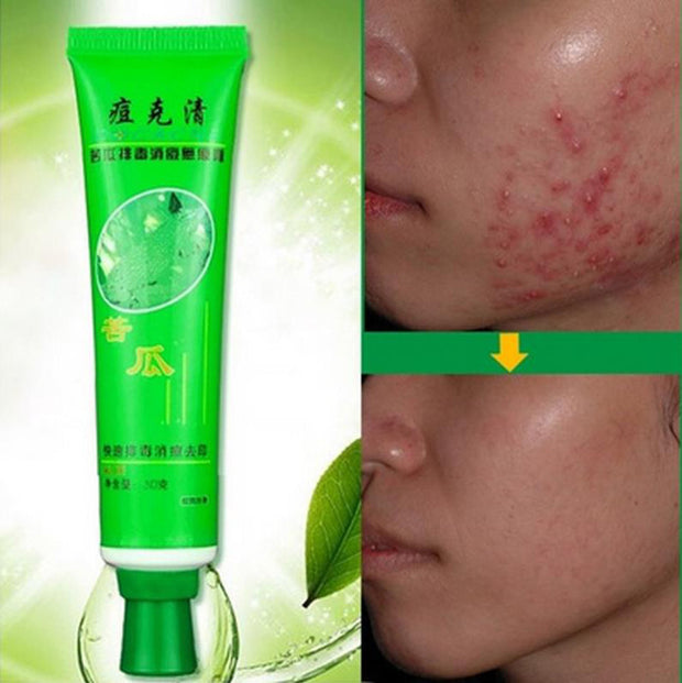 30g Face Skin Care Acne Cream Oil Control Acne Products Face Cream beauty